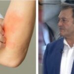 Ylli Merja, Anemia